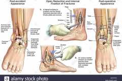 1965-07-03-ArnoldLD1929-Comminuted-fracture-of-distal-left-tibia-and-fibula